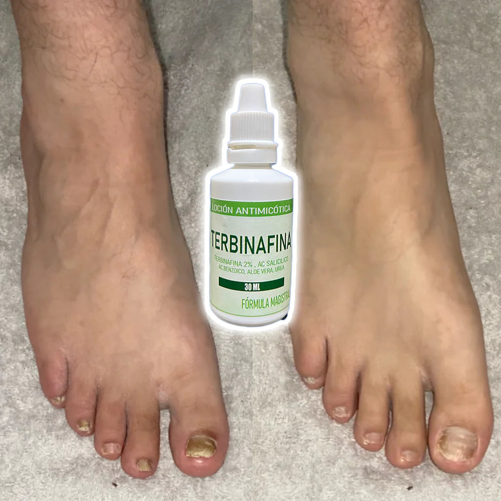 GOTAS DE TERBINAFINA - PARA HONGOS EN LAS UÑAS