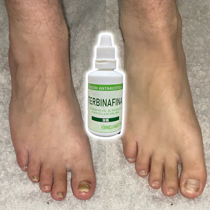 GOTAS DE TERBINAFINA - PARA HONGOS EN LAS UÑAS